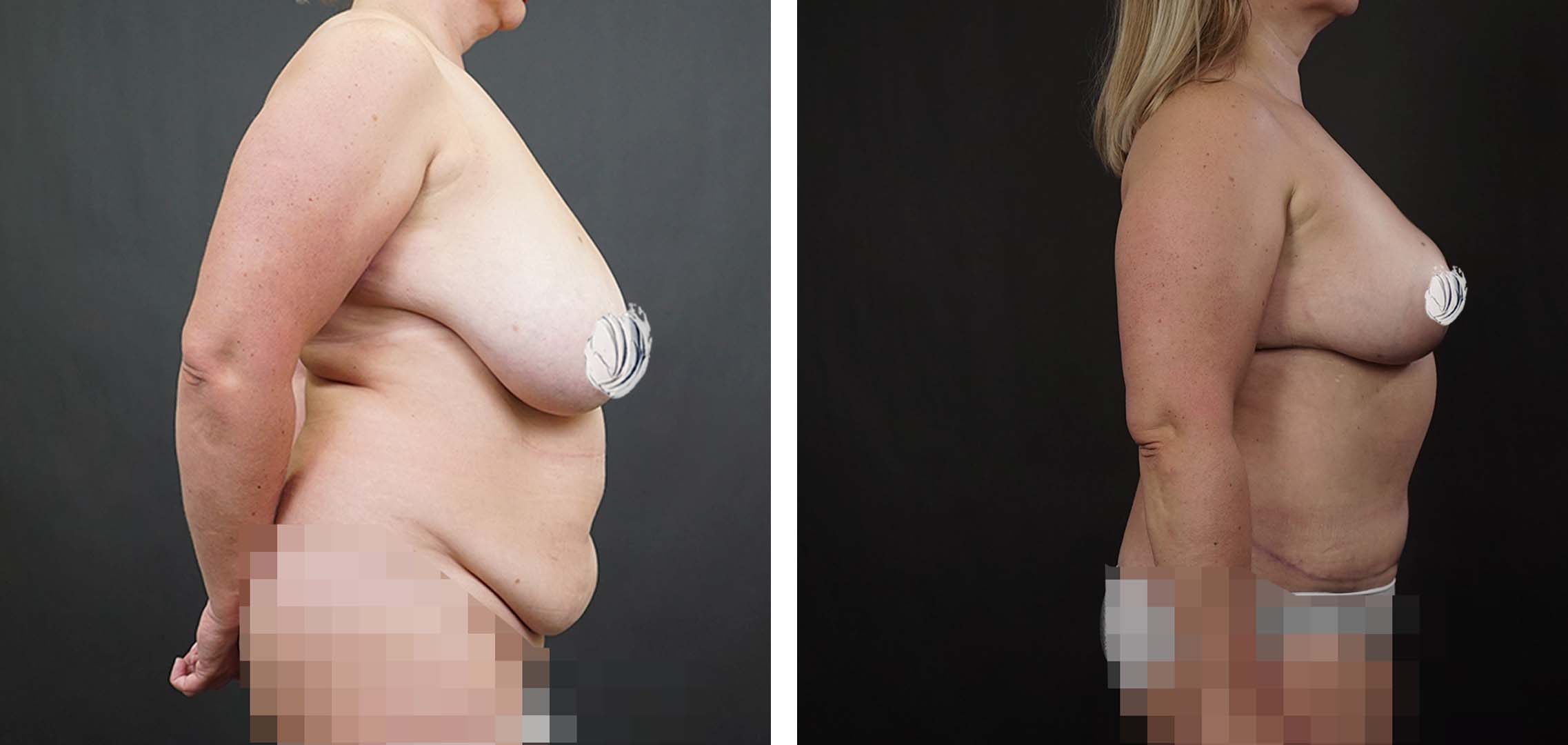 грудь после родов у женщин фото 67