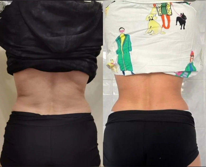 убрать бока без липосакции в Москве