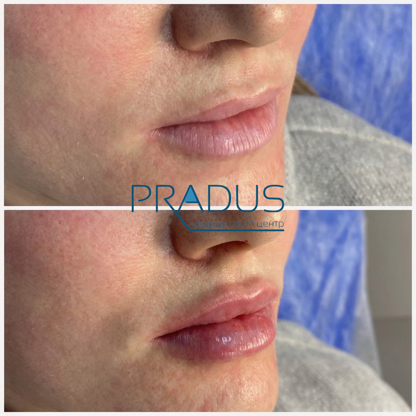 До и после контурной пластики губ. Увеличение объёма без утяжеления. PradusCOSMO, Васильевский остров