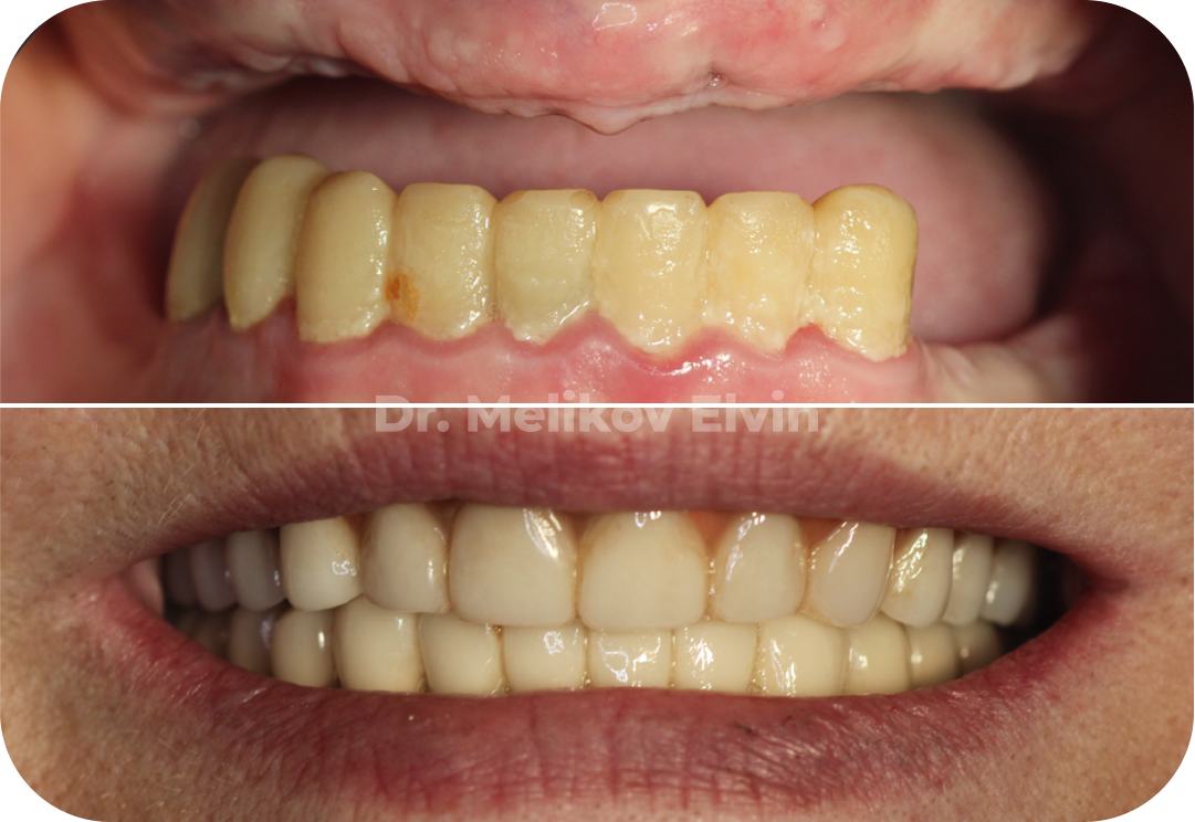 Полная имплантация зубов в Москве