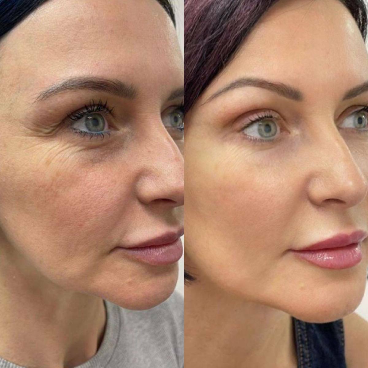 Процедура холодная плазма для лица в студии Vtrende в Ессентуках