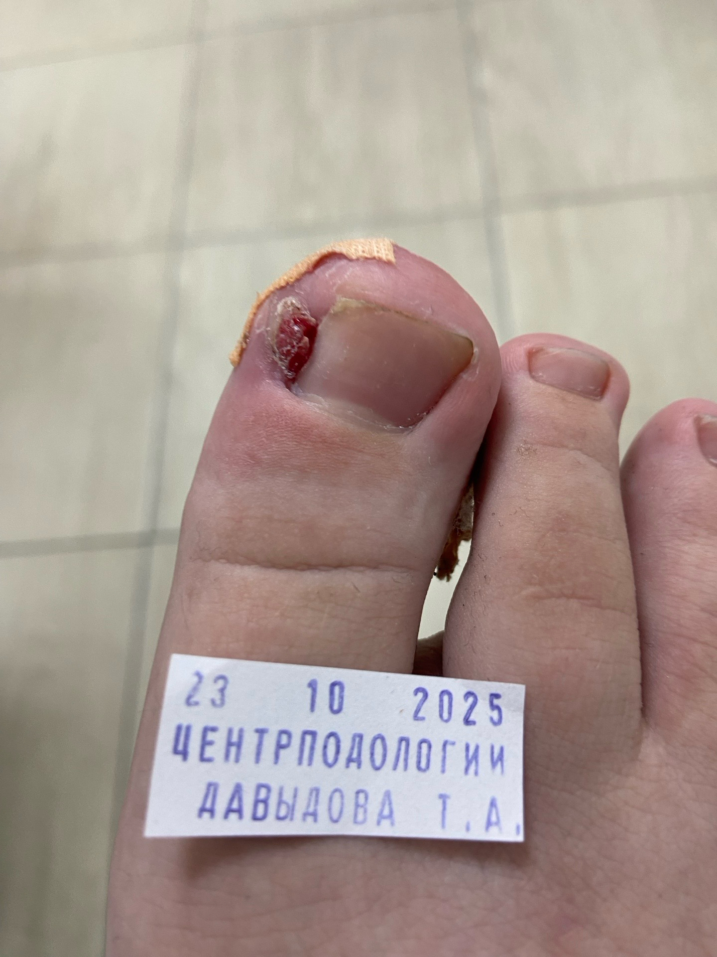 первые признаки вросшего ногтя