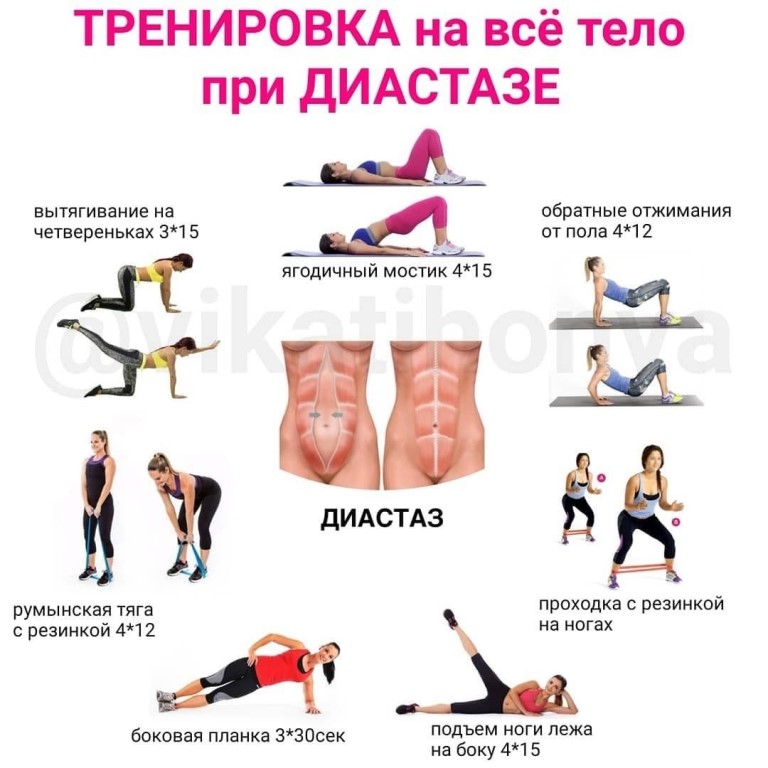 Как избавиться от диастаза: операция, упражнения, массаж