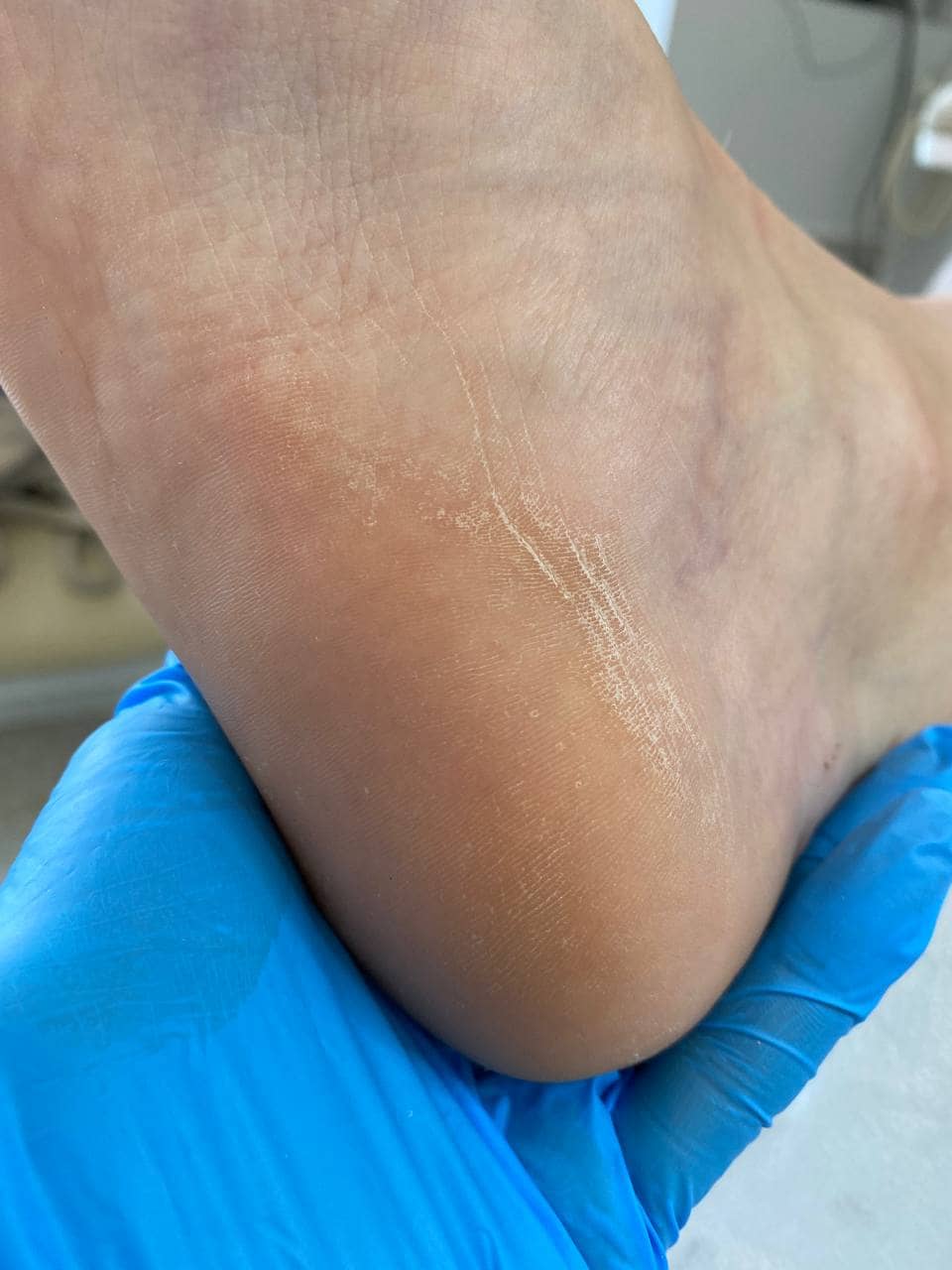 Трещины на стопе