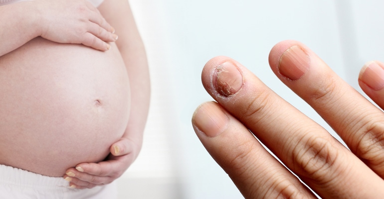 Лечение молочницы (кандидоза) при беременности - в первом, втором и третьем триместре в ОН КЛИНИК