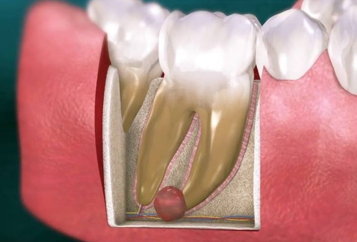 Сколько болит зуб после удаления кисты