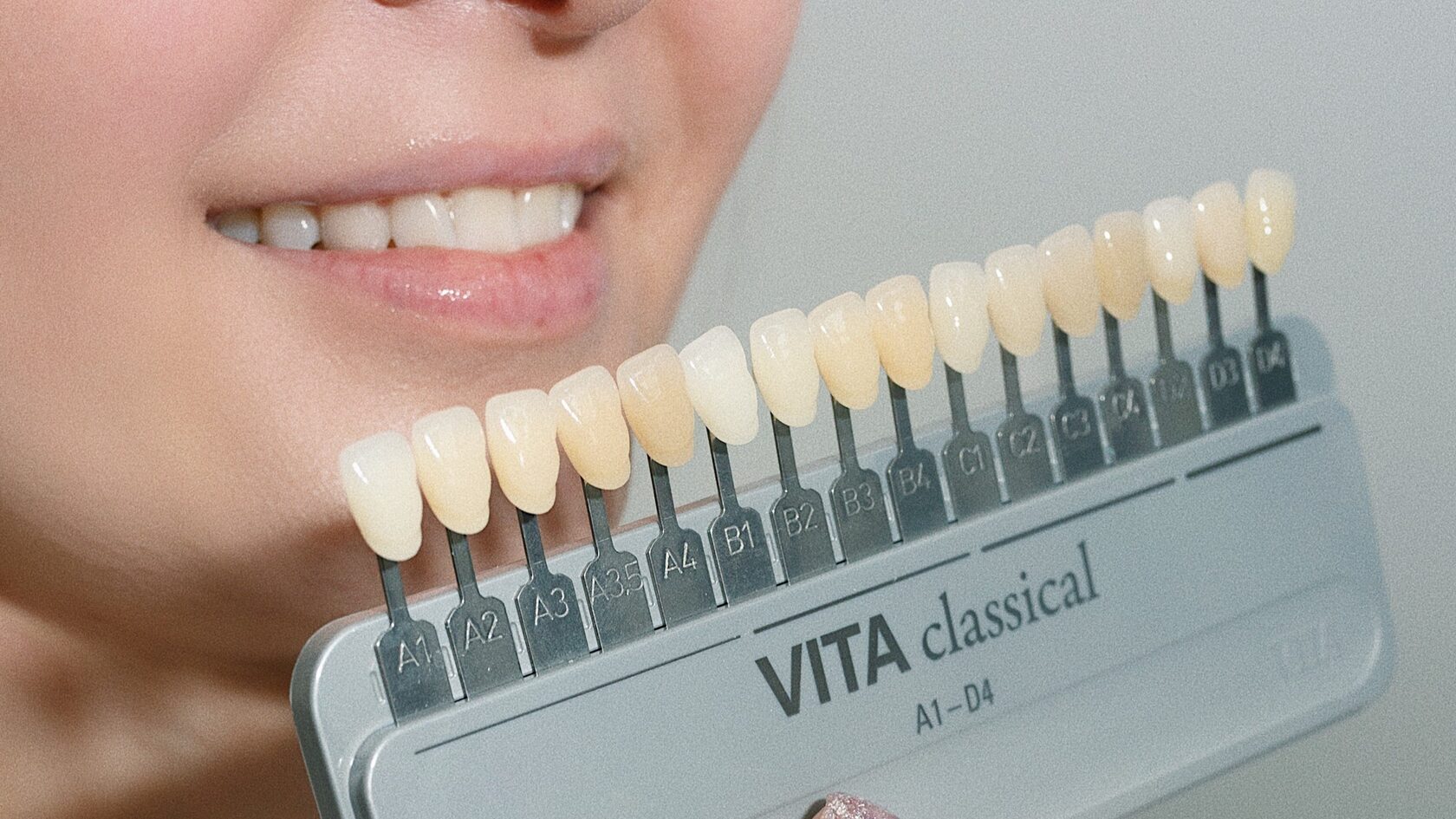 что такое виниры