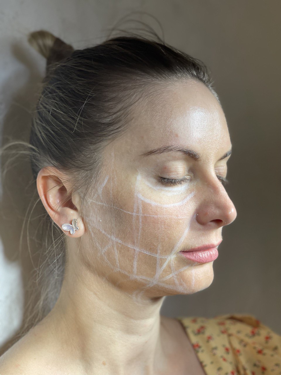 Ultherapy Cost at Borsalo Med Spa Everything You Need to Know