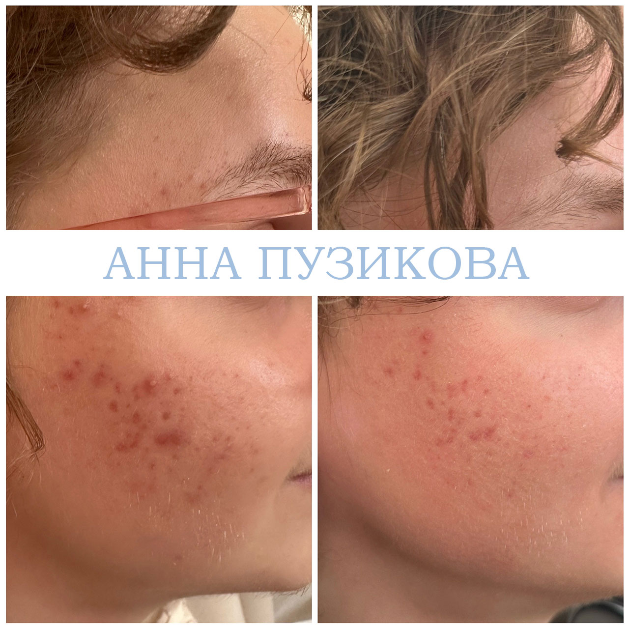 Результат лечения акне и воспалений кожи после курса процедур у косметолога Анны Пузиковой в клинике Прадус (СПб).