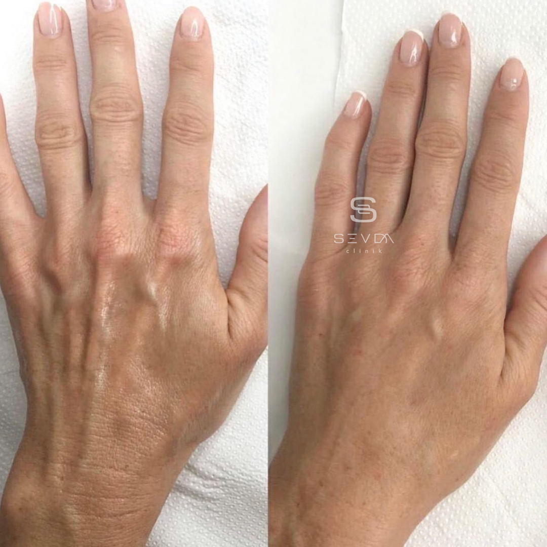 Рецензия рука. Биоревитализация рук до и после. Биоревитализация кистей рук. Биоревитализация кожи рук.