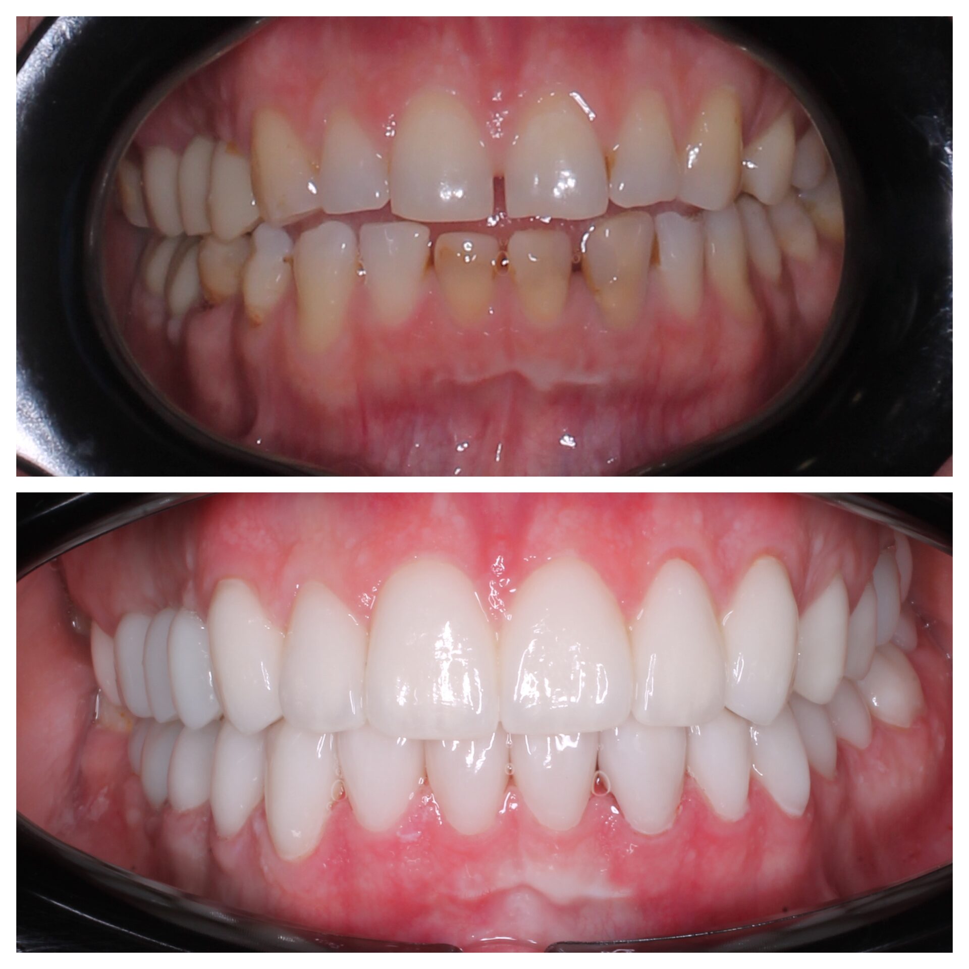 имплантация зубов чебоксары,имплантация зубов йошкар-ола,тотальная реабилитация на 6 имплантатах,протез несъемный в чебоксарах,виниры в чебоксарах,виниры на зубы москва,виниры чйошкар-ола