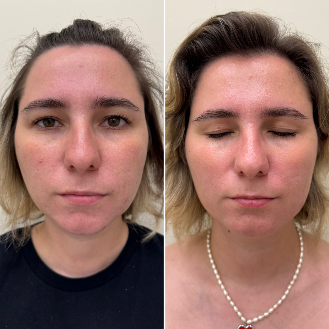 Результат нашей пациентки после комплекса процедур