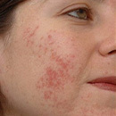 rf-лифтинг лица