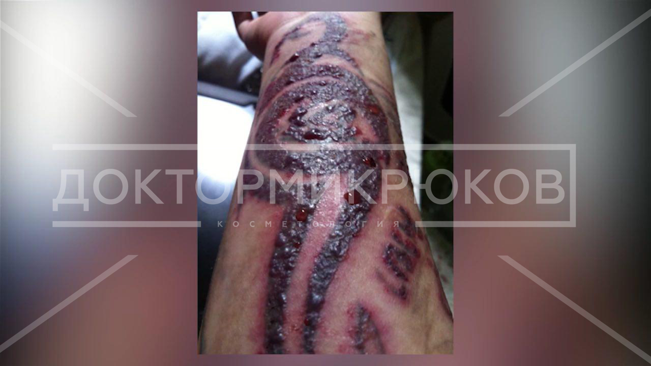 Как удаляют татуировки лазером и что будет с кожей после этой процедуры