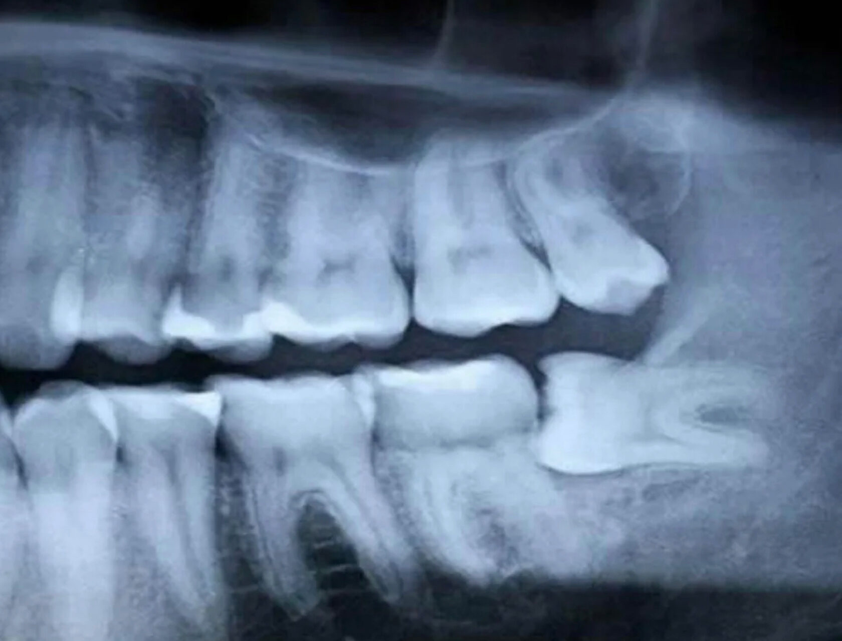 фото кости после удаления зуба