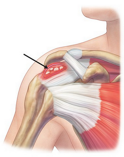 Особенности лечения плечевого сустава
