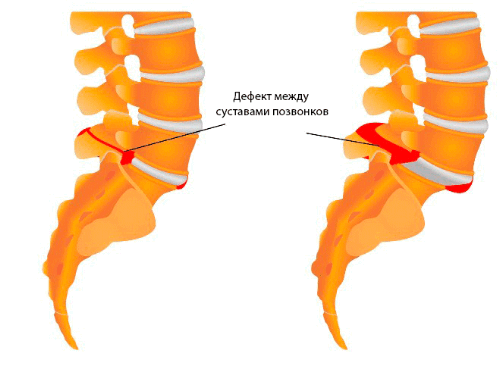 Лечение спондилолистеза у детей и взрослых. Операции при спондилолистезе