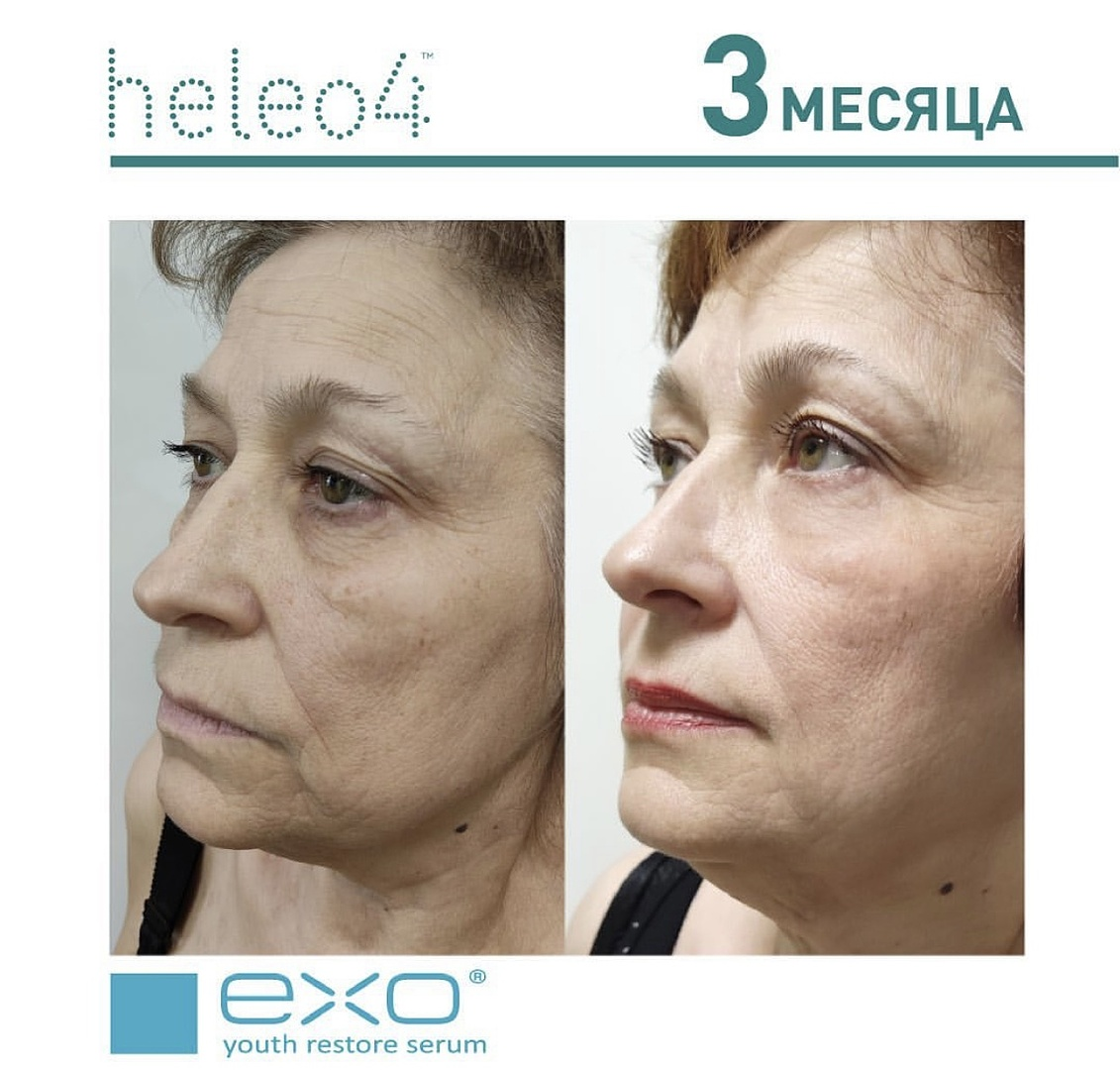 Фото ДО и ПОСЛЕ косметология клиники Олимп