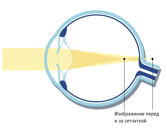 У человека с близорукостью изображение фокусируется