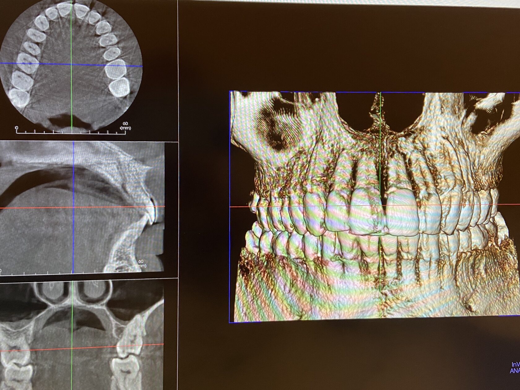 Кт ротовой полости. Компьютерная томограмма зубов. Компьютерная томография зубов 3d.