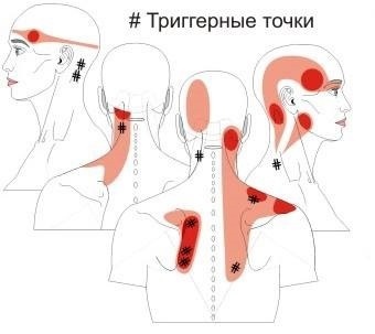 Триггерные точки: лечение методом мануальной терапии