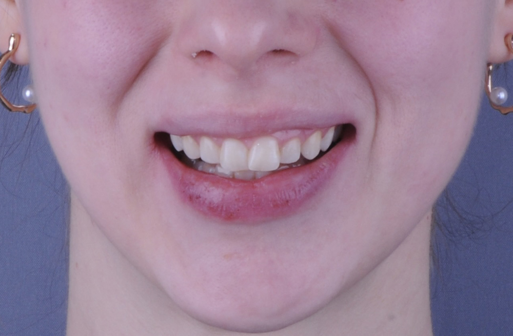 Исправление глубокого прикуса и выравнивание зубов брекетами без операции