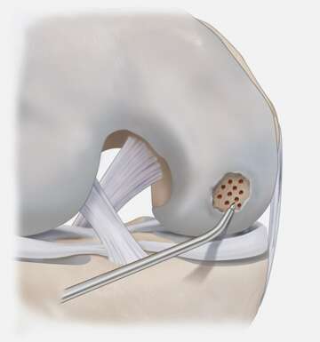 Микрофрактурирование мыщелка бедренной кости