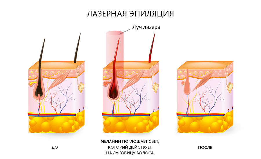 Когда выпадают волосы при лазерной эпиляции?