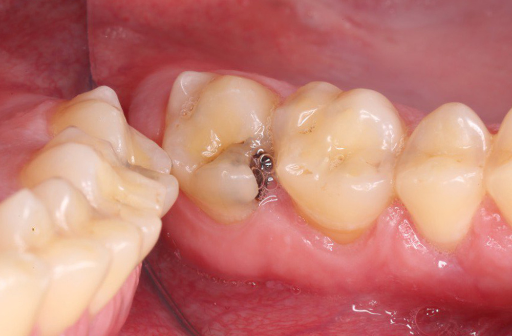 Клинический случай спасения зуба с обширным сколом через лечение корневых каналов и протезирование