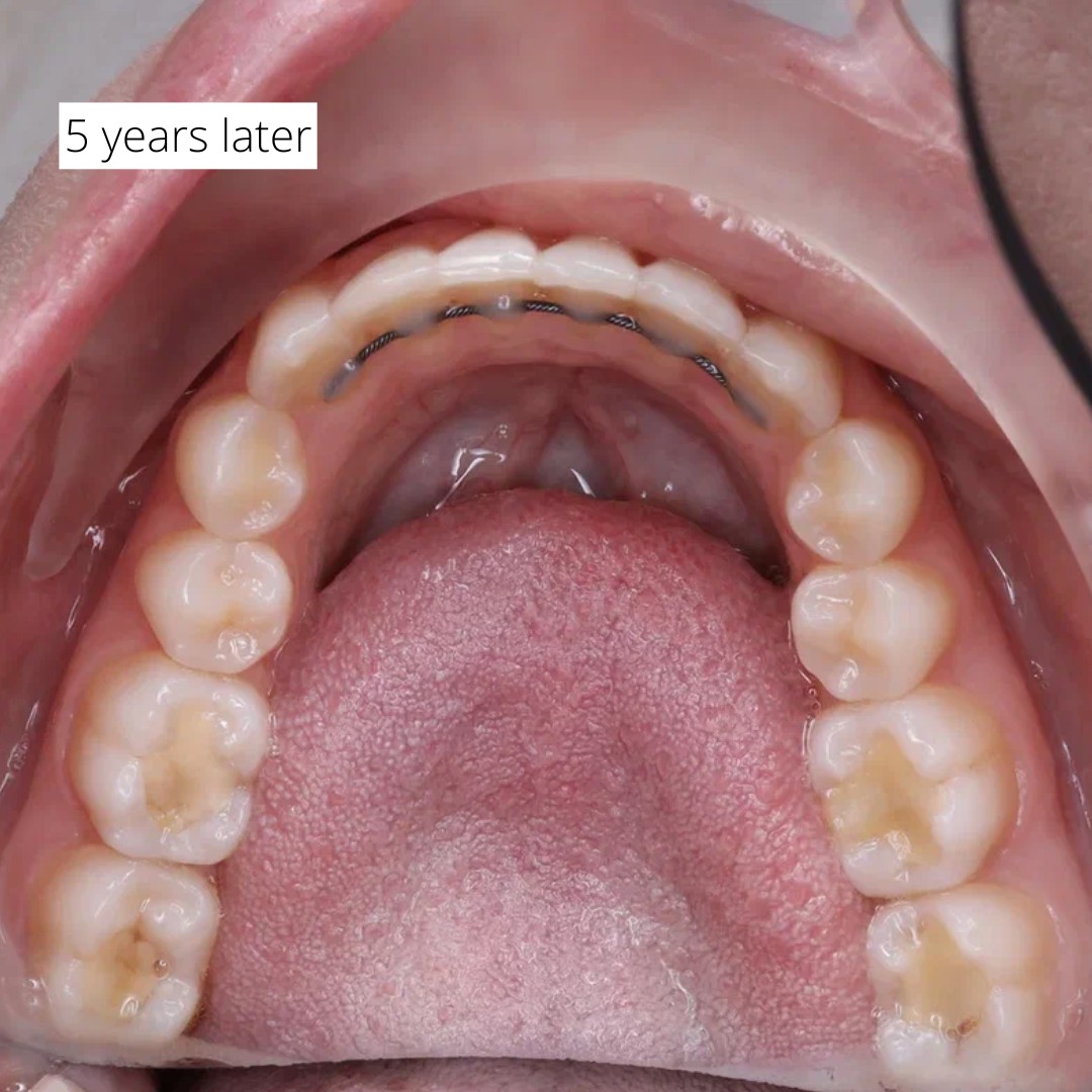 Near-completion view showing resolved crowding and corrected bite relationship — photo 5 of 6