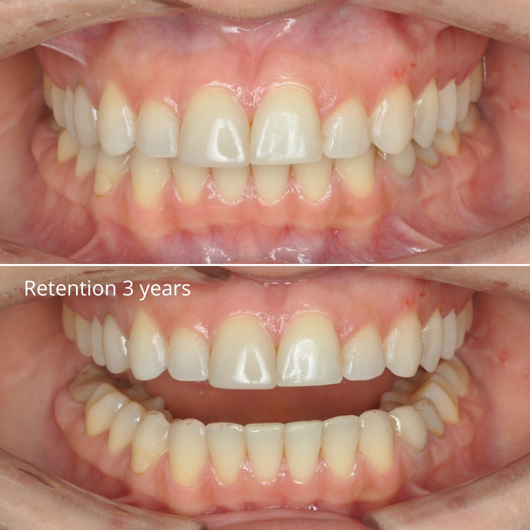 Stage showing the smile arc nearing symmetry — photo 4 of 5