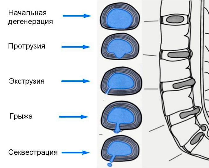 Экструзии межпозвонковых дисков: симптомы и лечение | Клиника Temed