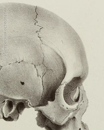 Птерион и краниосакральная система Epipteric-тип