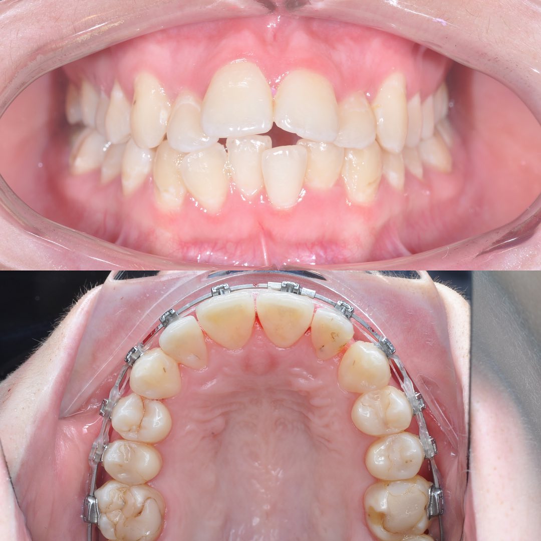 Before treatment view of the constricted maxillary arch prior to MARPE expansion