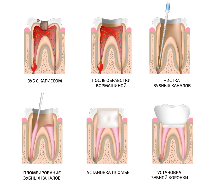 Удаление нерва зуба схема