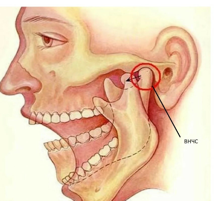 Причины хруста в челюсти