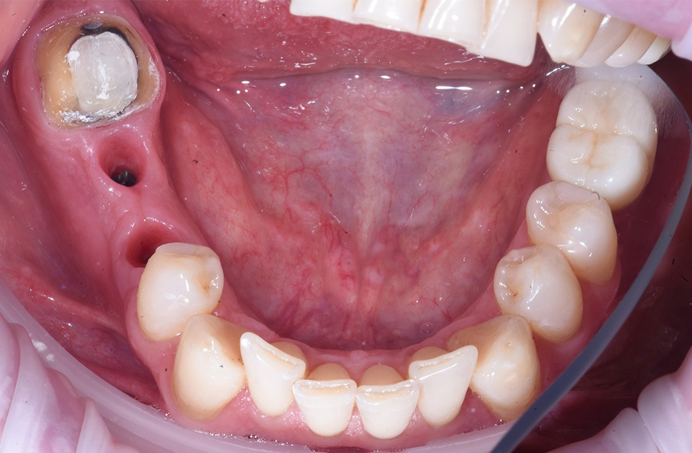 Восстановление зубного ряда у пациента с применением имплантов Osstem и циркониевых коронок