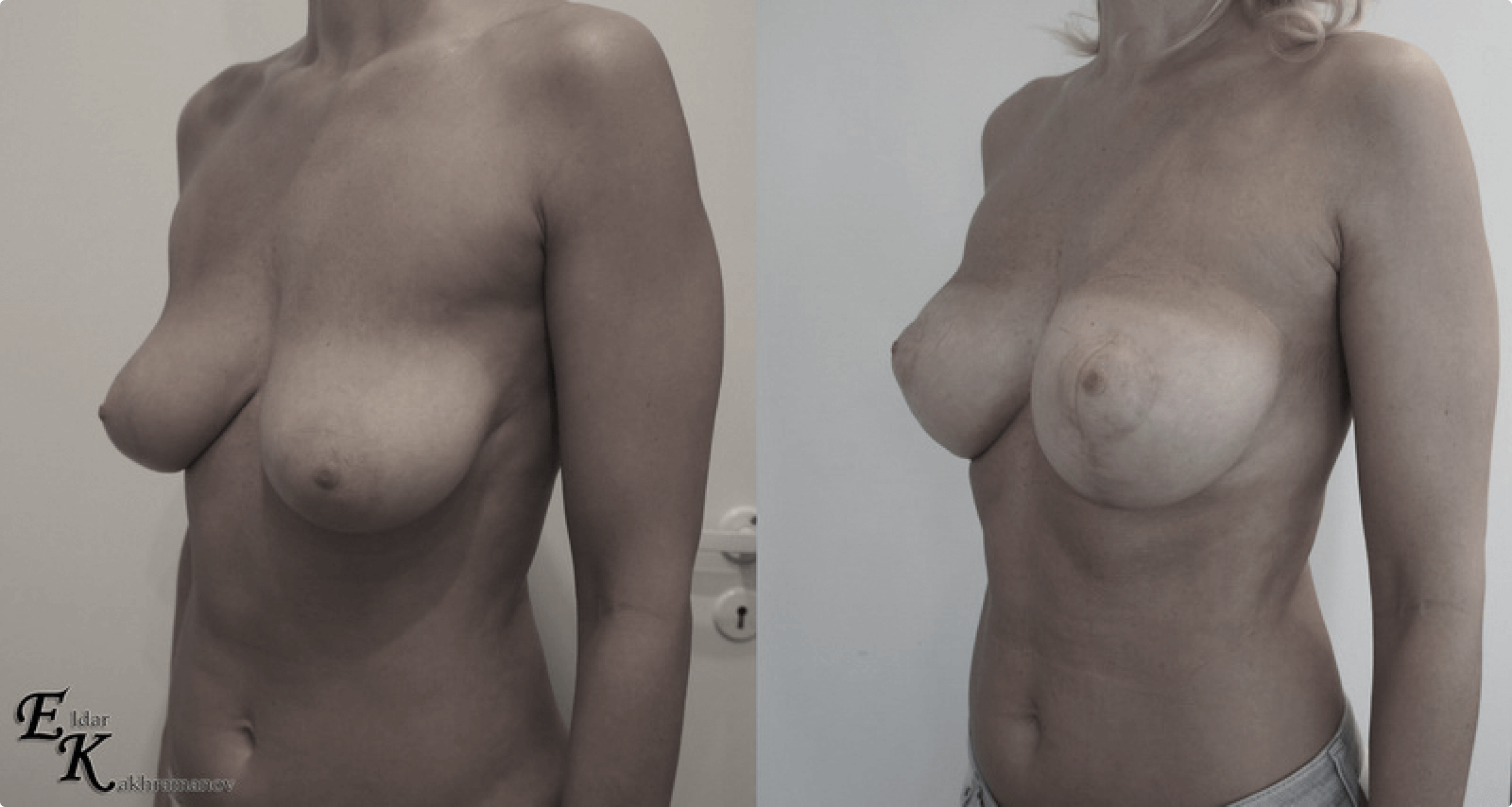 липосакции груди у женщин фото 13