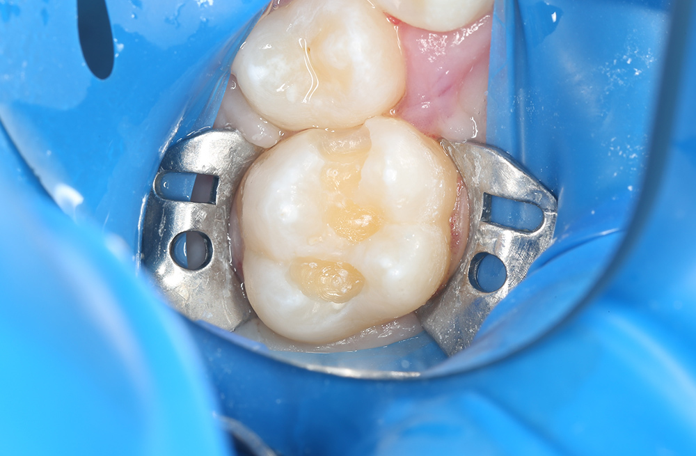 Удаление среднего кариеса с пломбированием зуба композитным материалом