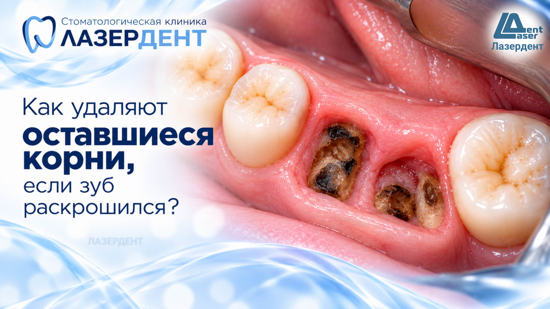 Как удаляют оставшиеся корни, если зуб раскрошился — удаление корней зуба в Лазердент Хабаровск