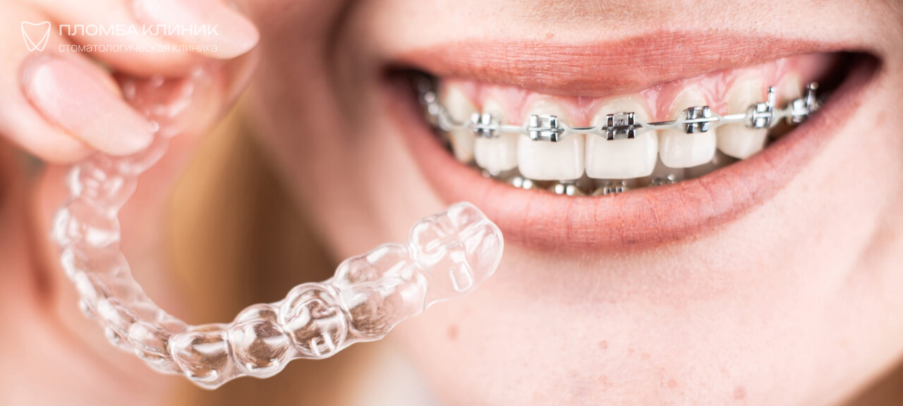 исправление прикуса