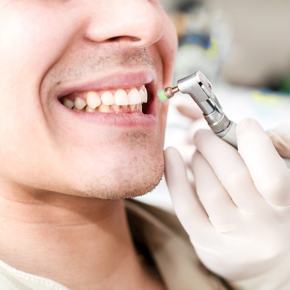 Как стоматологи делают чистку зубов. Профгигиена (ультразвук + Air-Flow). Профгигиена полости рта Air Flow. Профессиональная чистка зубов. Чистка зубов в стоматологии.