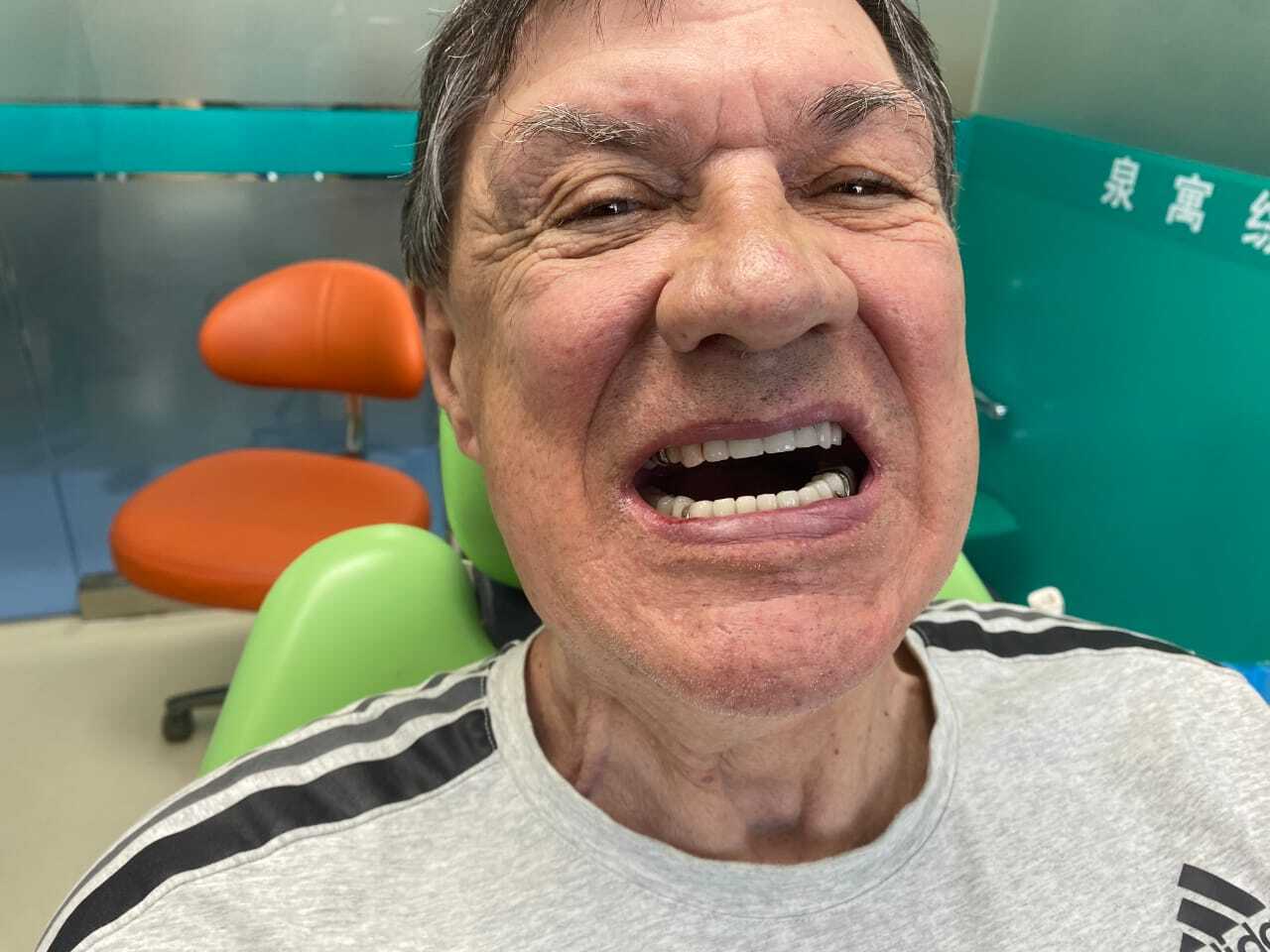 новые зубы после лечения в Китае