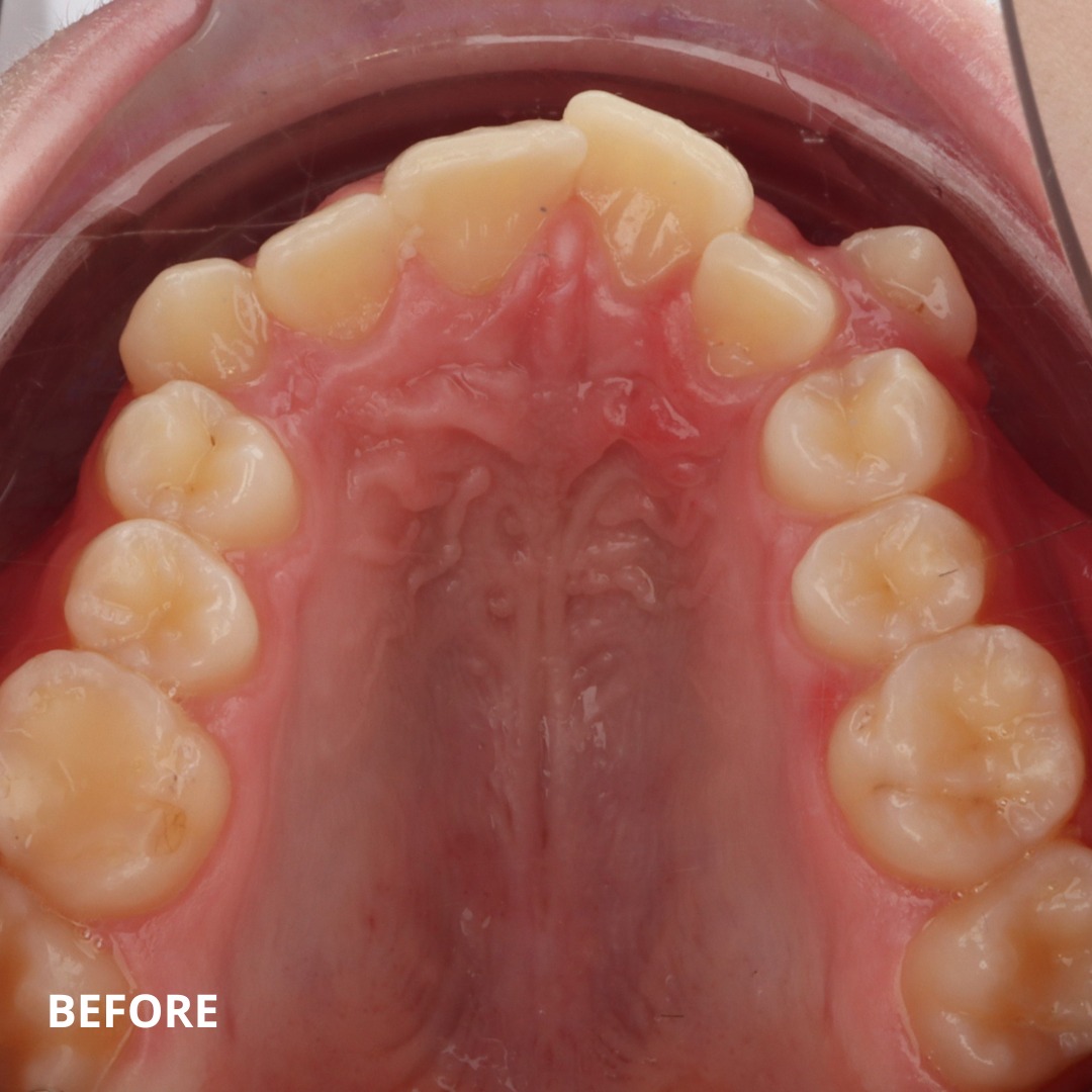 Stage view showing continued space correction through combined skeletal and distalization approach — photo 4 of 5