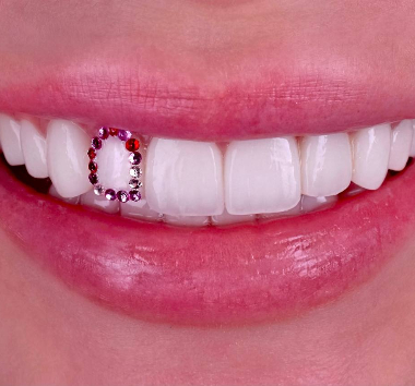 Установка виниров