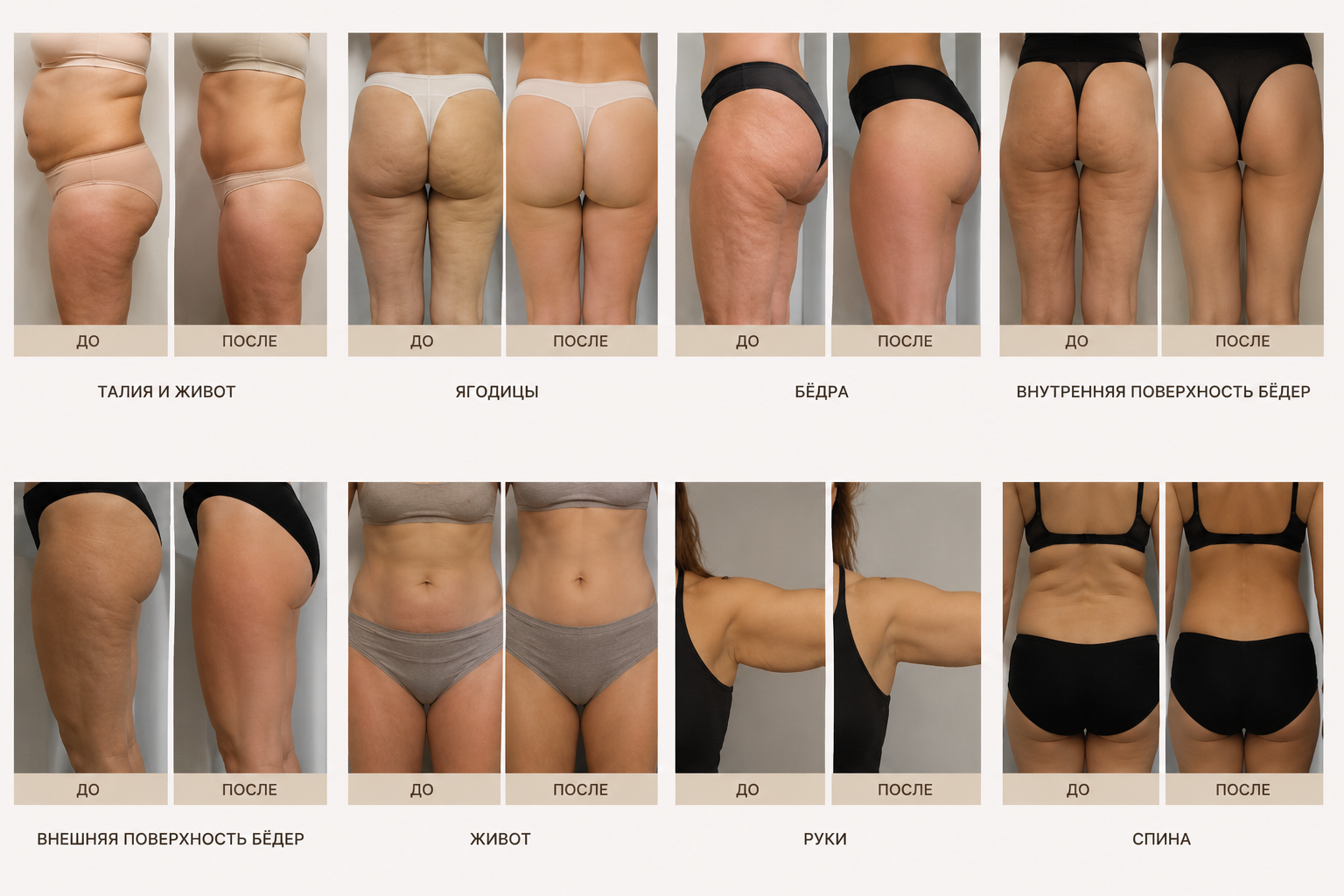 Результаты процедур Velashape: до и после