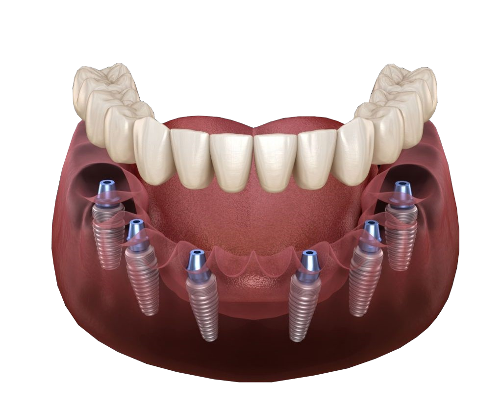 Протезирование зубов в казани. Имплантация зубов по технологии «all on 4». Имплантация челюсти на 6 имплантах.