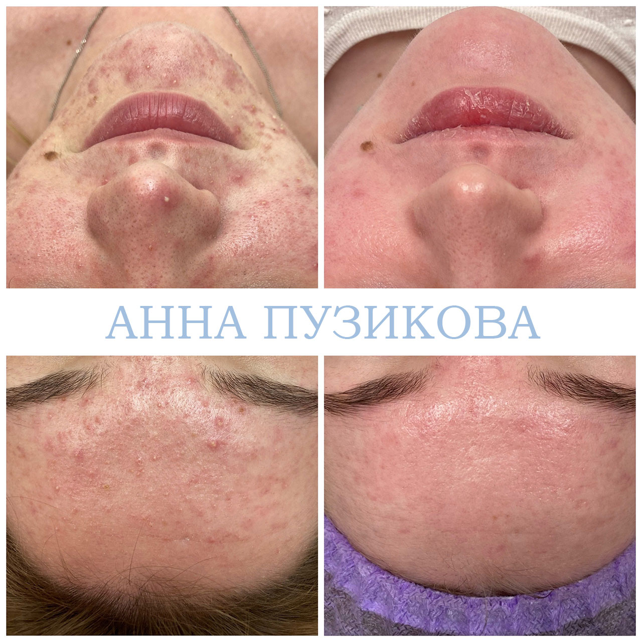Результат лечения акне и воспалений кожи после курса процедур у косметолога Анны Пузиковой в клинике Прадус (СПб).