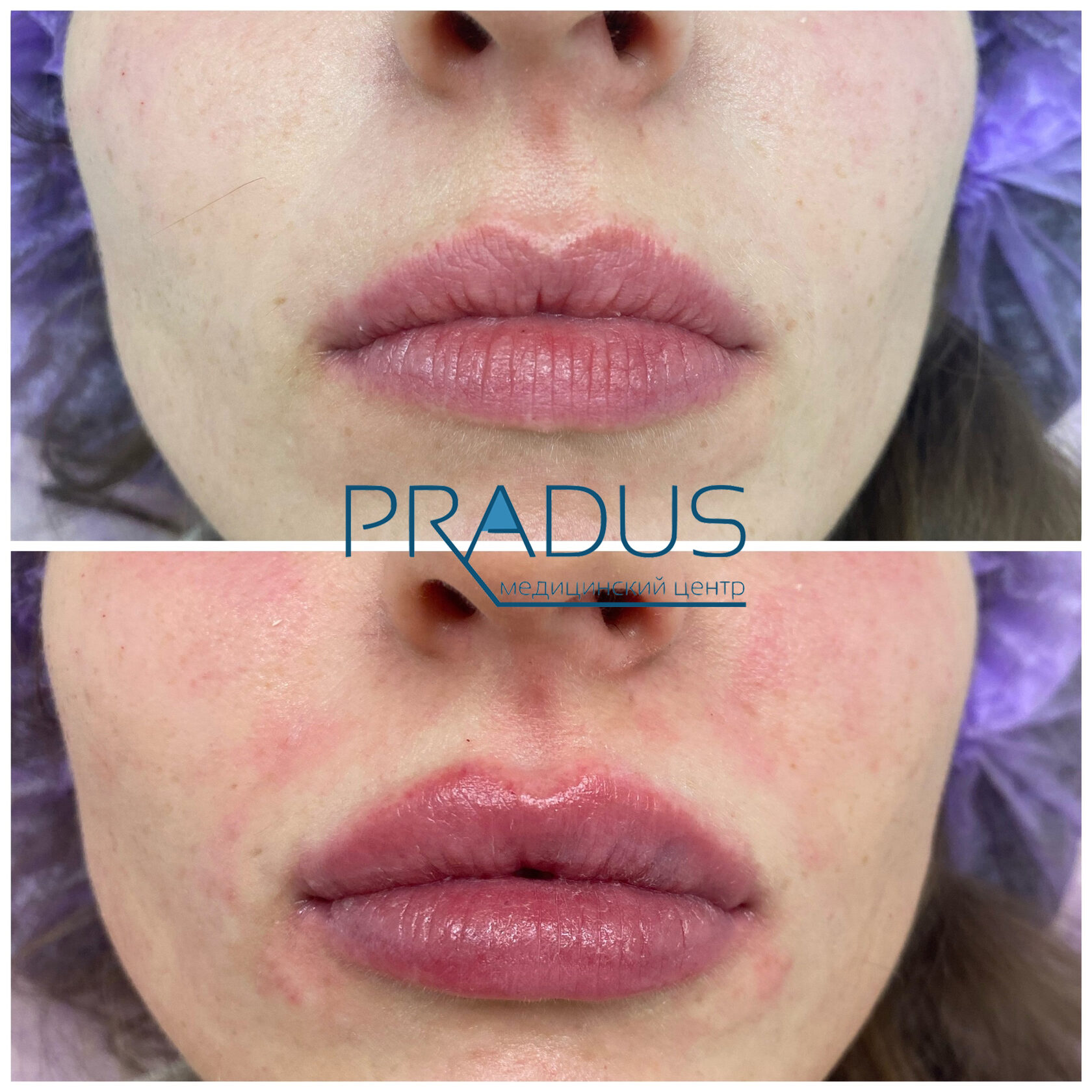 До и после контурной пластики губ. Увеличение объёма без утяжеления. PradusCOSMO, Васильевский остров