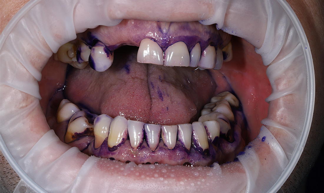 Удаление зубного камня и налета